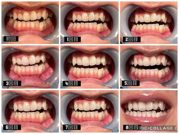 パルティノ 高崎店/【症例】セルフホワイトニング☆