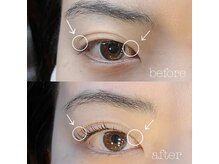 バービーヒルズ/二重が定着！