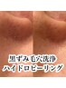 毛穴洗浄ハイドロフェイシャル＋超保湿ヒト幹細胞パック¥5250→¥4500