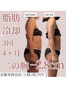 アイビー(IVY)/全身脂肪冷却モニター