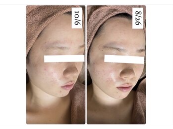 ホワイトアクア 北千住店(WHITE AQUA)/ハーブピーリング2回/ニキビケア