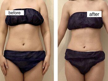 ルシエル ハカタ(Luciel HAKATA)/痩身120分×1ヶ月(20代)