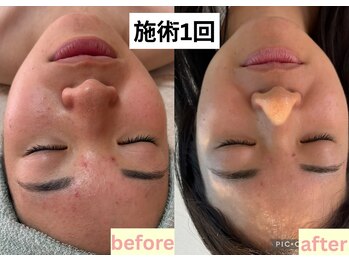 アドミーロ/ハーブピーリング1回/剥離なし