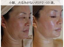 ラグランシエル(Le grand ciel)/ハリ感×リフトアップ