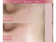ローズドゥシャロン(Rose de CHALON)の雰囲気(【黒ずみ毛穴・角栓・皮脂撃退】汚れを洗い流し毛穴も引き締め★)