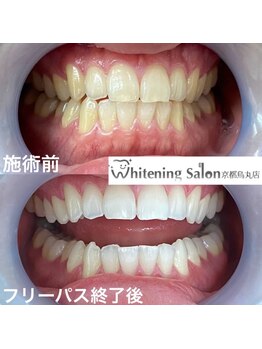 ホワイトニングサロン 京都烏丸店/ホワイトニング施術例