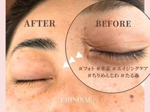 エミニナル(EMININAL)
