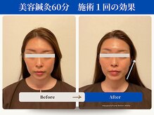 和ら/たるみ/肩首こり//噛み締め/小顔