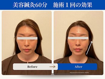 和ら/たるみ/肩首こり//噛み締め/小顔