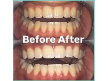 ララホワイトニング/