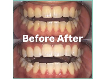 ララホワイトニング/