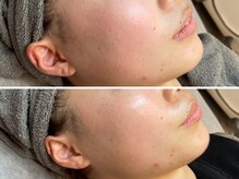 モーヴサロンエトフルール(mauve salon.et.fleurs)/ラミネーションピール・施術