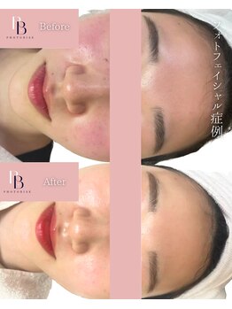 フォトビズ/フォト光フェイシャル真皮改善