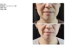 ラネージュ/レモンボトル3回