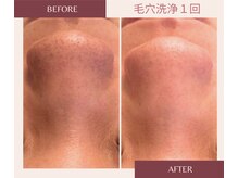 アブニールブリヨンの雰囲気（気になる毛穴にアプローチ！黒くなりやすい小鼻に[肌質改善]）