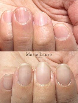 マリーロール 梅田店(Marie Laure)/自爪育成/深爪矯正/ネイルケア