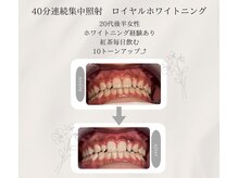 プラスビーセルフ(+b self)/ホワイトニングビフォーアフター