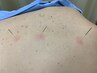 【腰痛お悩みに】身体の鍼ケア+ほぐし+腰痛整体50分¥6150⇒¥5500