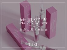 ツキ(TUKI+)/施術１回で黒ずみを元のピンクに