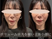 チョコバリ 郡山店(chocobari)/小顔×リフトアップ(美容鍼)30代