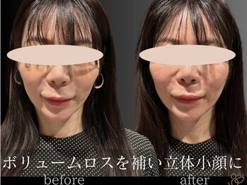 チョコバリ 郡山店(chocobari)/小顔×リフトアップ(美容鍼)30代