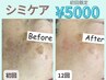 クーポン人気No.1【SNSで話題シミ専用機器が熊本光の森】シミケアお試し¥5000