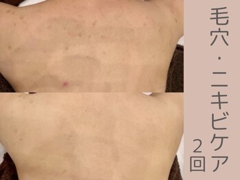 ベアール(beal)/背中ケア/ハーブピーリング2回