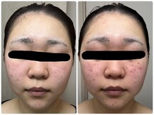 ツヤハダコガオ 千葉店/before⇒after 【プラズマ】