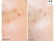 ルミラポー(Lumira Peau)/30代3回