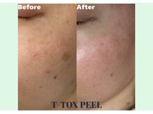 リシェリ 代官山(RICHERI)/日本初導入！T-TOX PEEL