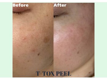 リシェリ 代官山(RICHERI)/日本初導入!T-TOX PEEL