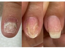 ロンディネ(Rondine)/トラブル自爪育成