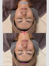 リラクゼーションラボ ユニコ(unico)/高周波でむくみ解消・小顔効果