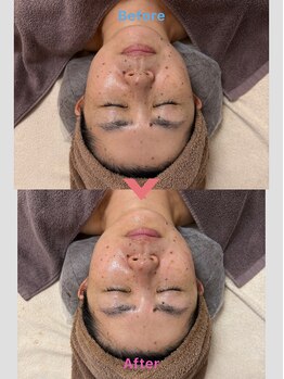 リラクゼーションラボ ユニコ(unico)/高周波でむくみ解消・小顔効果