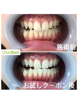 ルブラン 奈良店(Le Blanc)/効果の凄さ!!