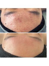 サロン ド ビューティージュエル(salon de beauty JEWEL)/プラズマニア陶肌トリートメント