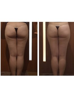 プリンセス バイ セイフティプリンセス 長野店(PRINCESS)/下半身痩せ特化メニュー