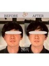 チョコバリ 錦糸町店(chocobari)/小顔×リフトアップ(美容鍼)20代