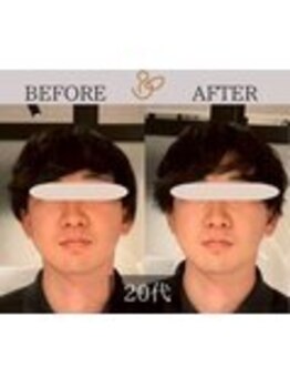 チョコバリ 錦糸町店(chocobari)/小顔×リフトアップ(美容鍼)20代