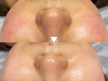 韓国肌管理◎冬の肌乾燥が気になる方！《毛穴洗浄×皮膚回復》ハイドラ＋白玉フェイシャル11000円