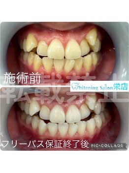 ホワイトニングサロン 名古屋 栄店/【ホワイトニング】