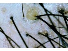 グラッシー(glassea)/頭皮の汚れ・つまり