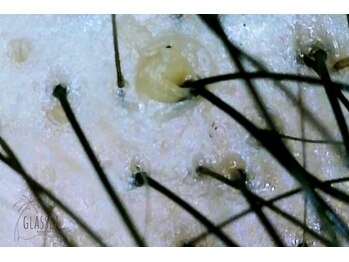 グラッシー(glassea)/頭皮の汚れ・つまり