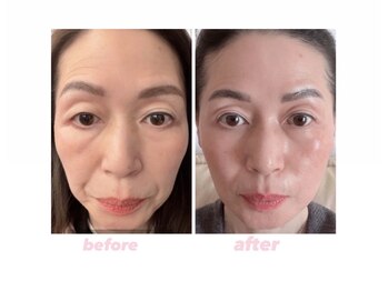 スリーメイ(3mey)の写真/栃木県初導入の本格ケア。高周波×インセルダムでハリツヤと肌質を同時に底上げ
