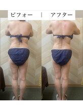 介正鍼灸整骨院 整体院 エフコープ大野城店/痩身エステ＊ビフォーアフター