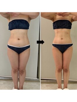 ミル(miru)の写真/【インディバ専門/歴13年】結果を求める女性の為の痩身インディバでサイズダウン×ボディラインを引締め!!