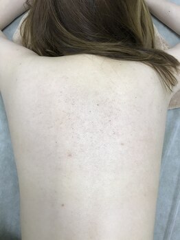 ナノハナ/鹿沼市全身脱毛ナノハナ