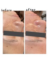 ニコリ(nicori)/大人気！フェイシャルワックス♪