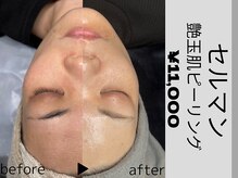 ウイ ネイルアンドビューティー(u'i nail&beauty)/艶玉肌セルマントリートメント