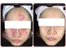 人気No,1 ●AI肌診断付き●根本から肌を変えたい肌質改善フェイシャル